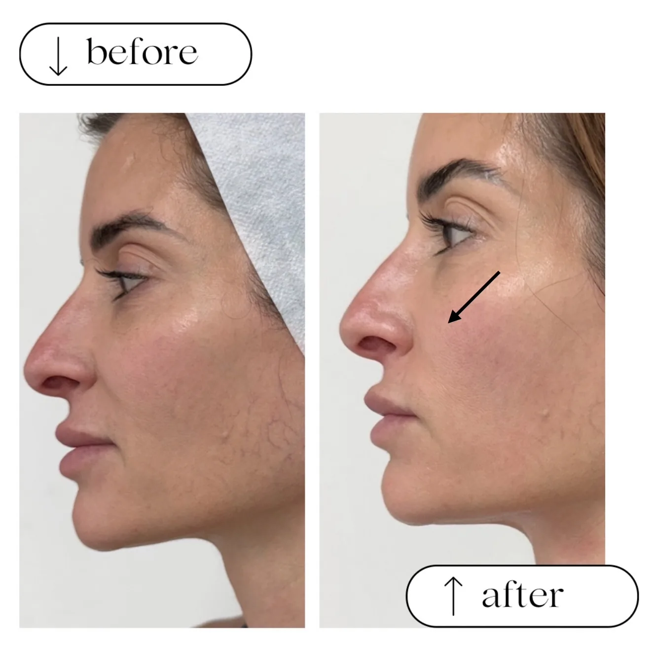 Before and after at Lotus MD: a woman's side profile, with an arrow marking the cheek in the after photo. Individual results vary.