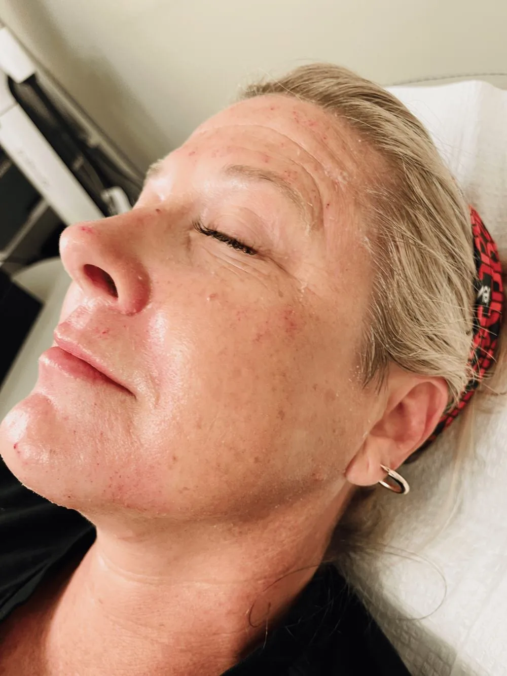 A woman resting on a treatment bed with flushed skin after a microneedling treatment