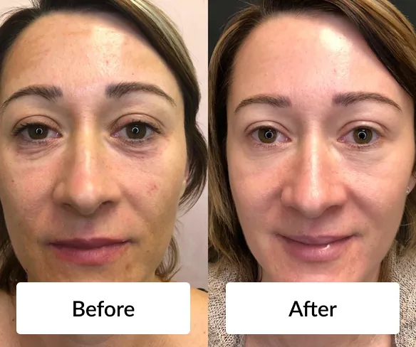 Before and after photos of a woman's face, with smoother, more even-looking skin in the after photo. Individual results vary.
