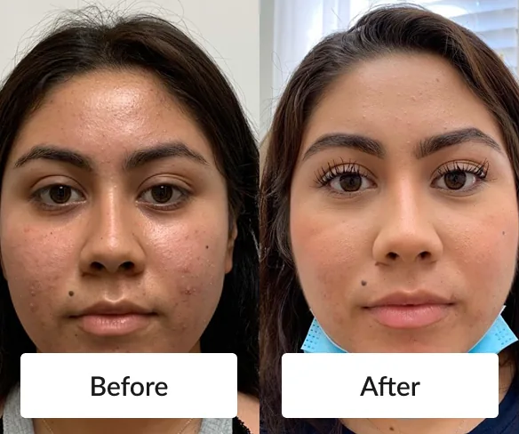 Before and after photos of a young woman's face, with fewer blemishes and a more even tone in the after photo. Individual results vary.