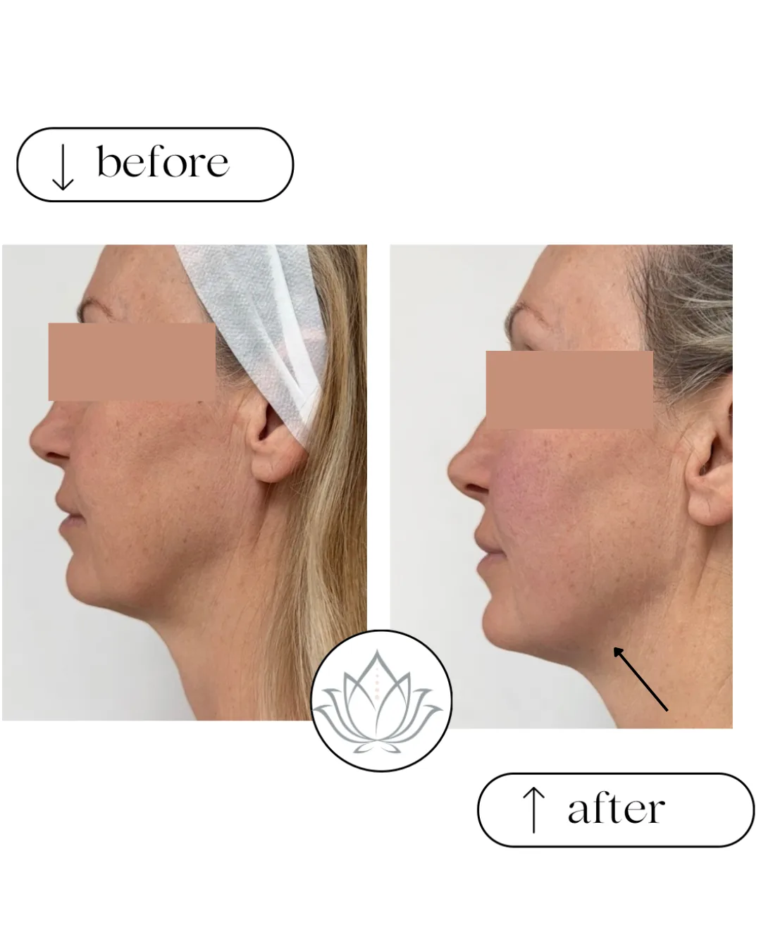 Side profile of a woman before and after treatment, eyes covered for privacy, an arrow marking the jawline in the after photo