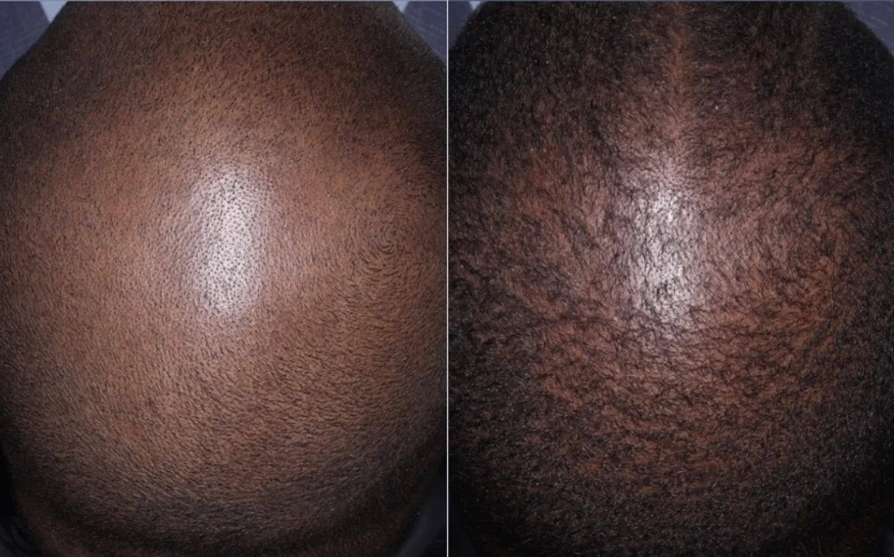 Overhead before and after photos of a patient’s crown with very short dark hair, showing more scalp before and denser hair coverage after