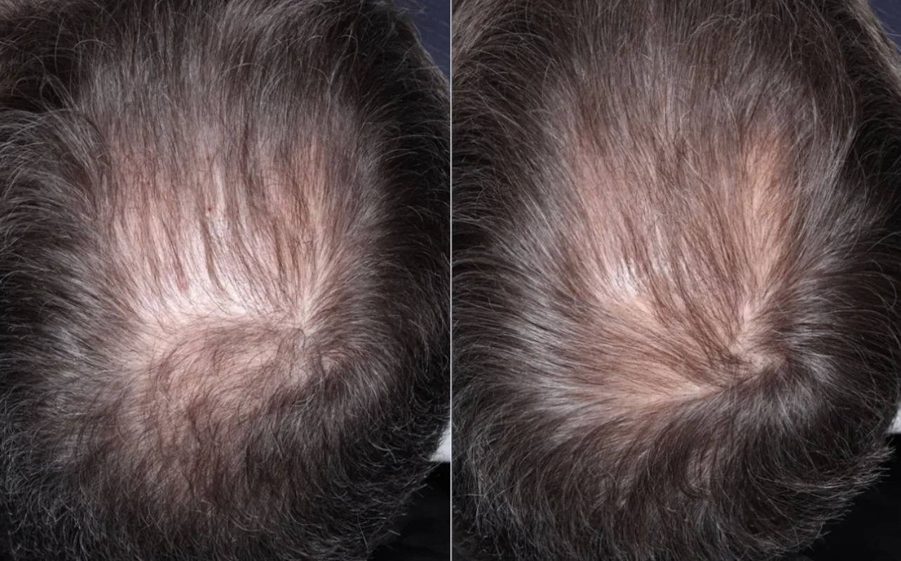 Overhead before and after photos of a patient’s crown with longer graying hair, showing less visible scalp after