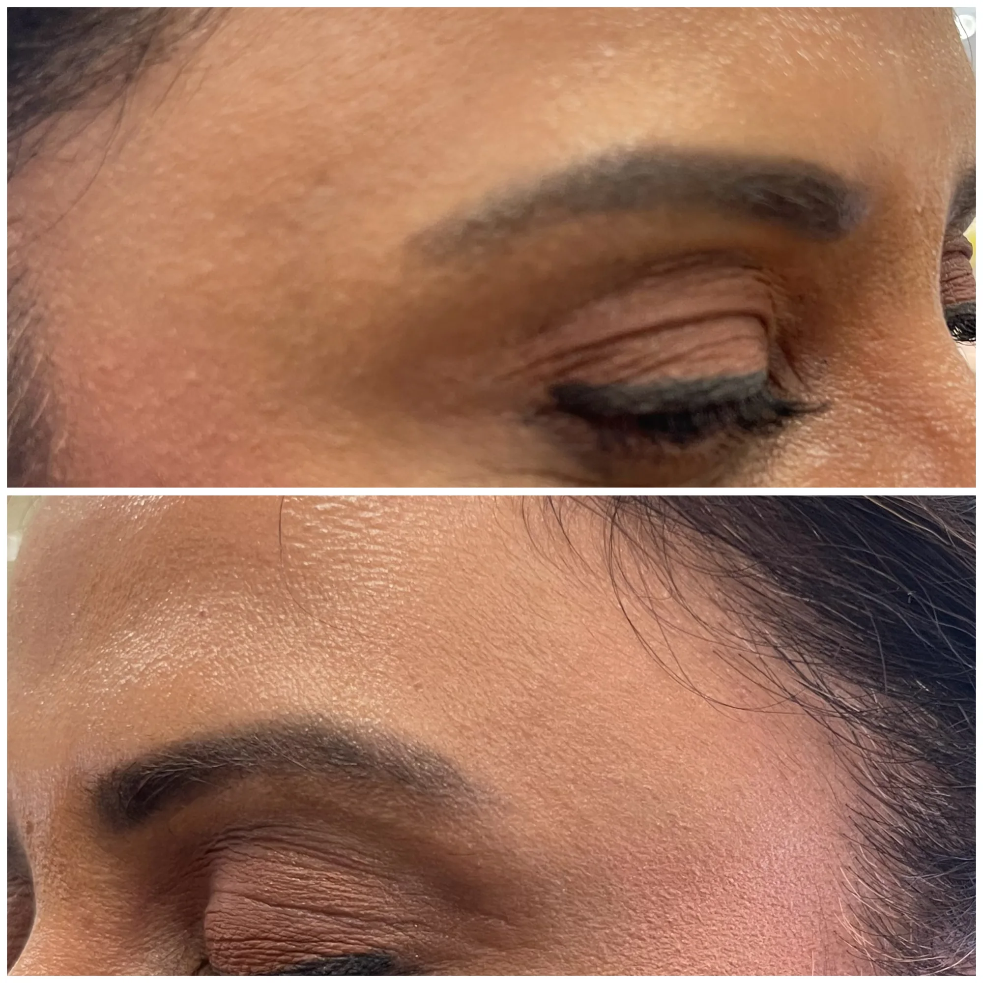 Before and after close-ups of a patient’s brow and upper eyelid, with the before photo on top and the after photo below