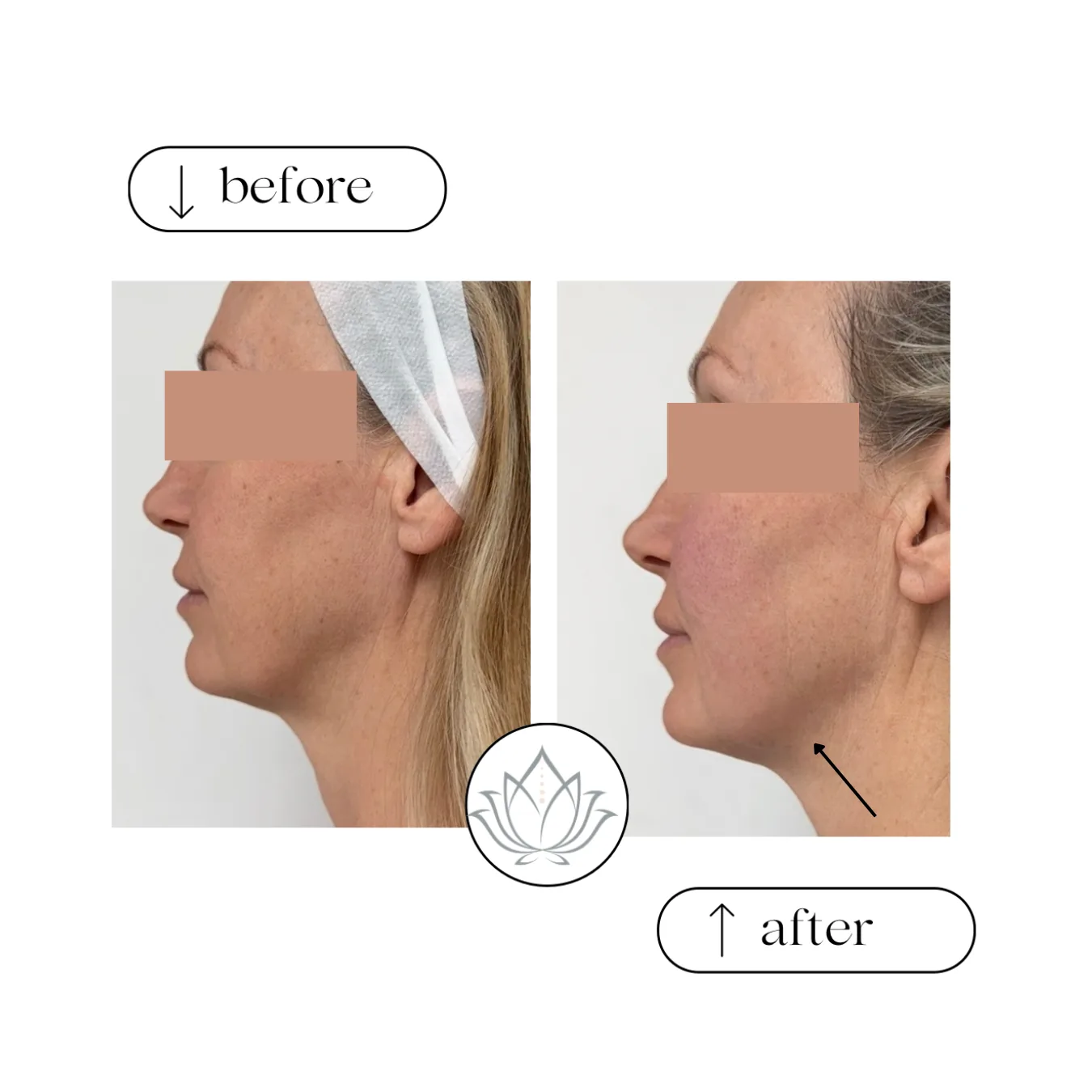 Side profile before and after photos of a woman with her eyes covered, with an arrow pointing to the jawline in the after photo