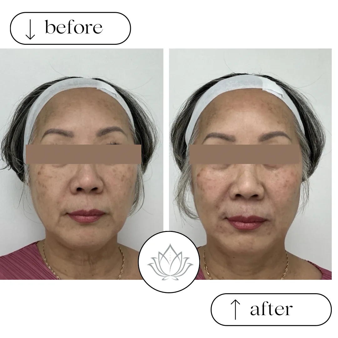 Front view before and after photos of an older woman with her eyes covered, showing pigmentation and skin texture