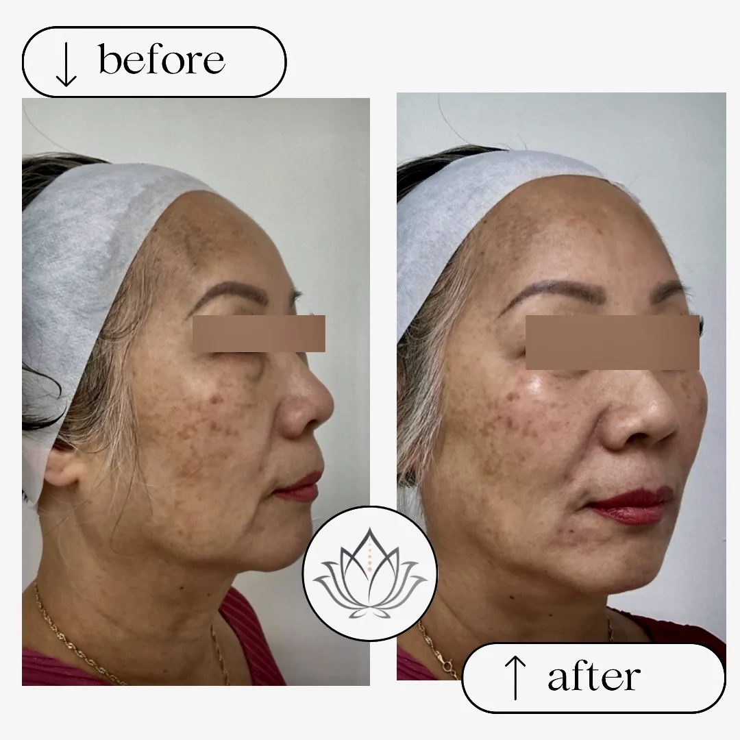 Three-quarter view before and after photos of an older woman with her eyes covered, showing brown spots and skin texture on her cheeks
