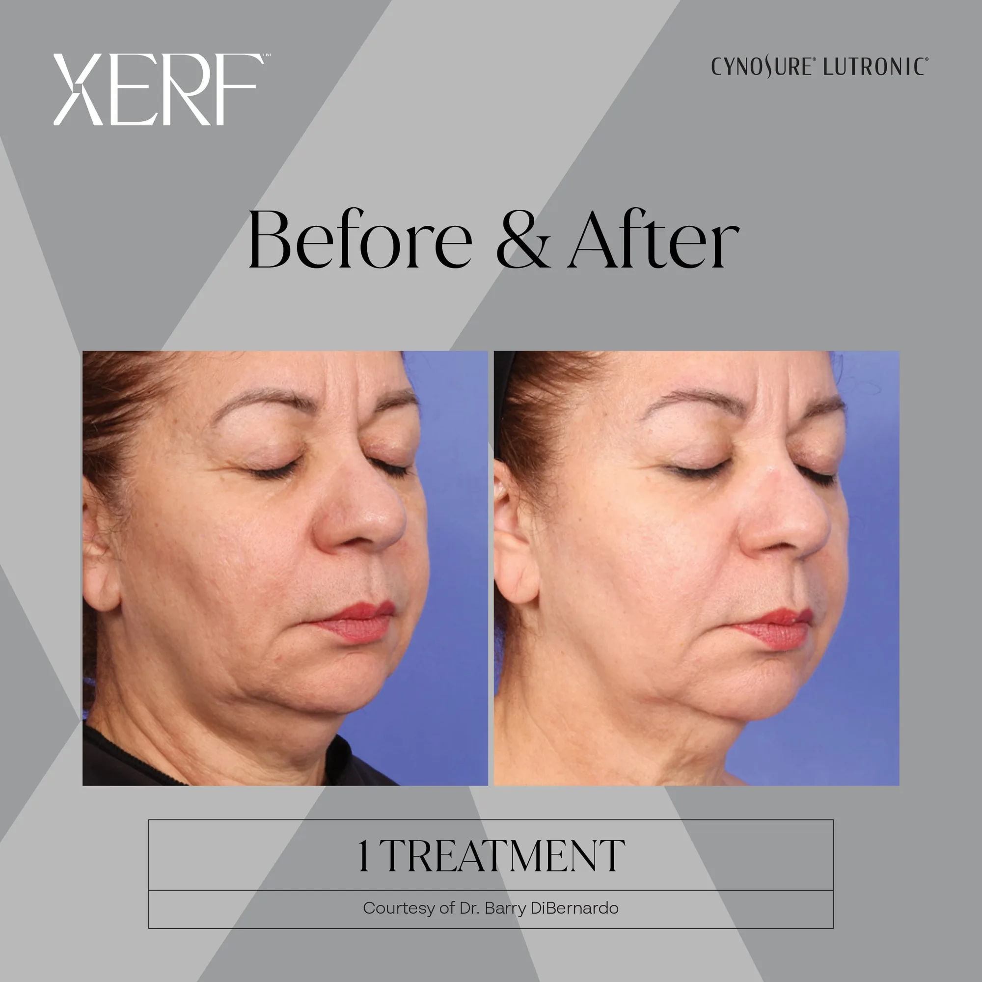 XERF before and after, three-quarter view of a woman's cheeks, jawline and neck after one treatment