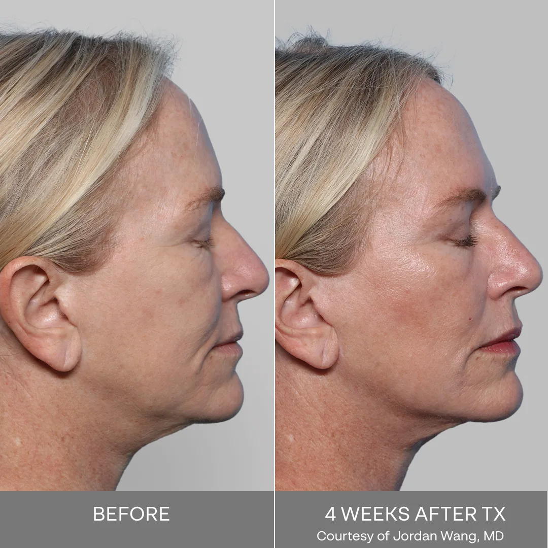 XERF before and after, side profile of a woman's face and jawline, before treatment and 4 weeks after