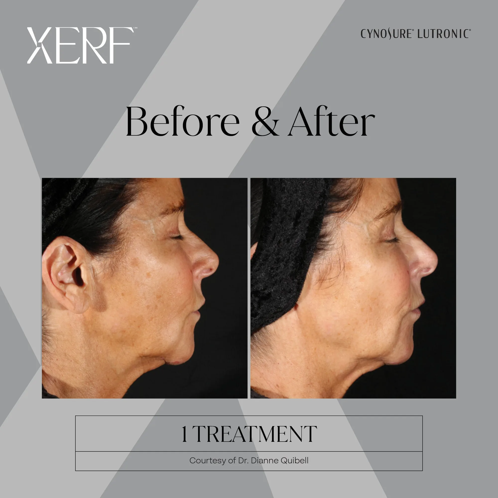 XERF before and after, side profile of a woman's lower face, jawline and neck after one treatment