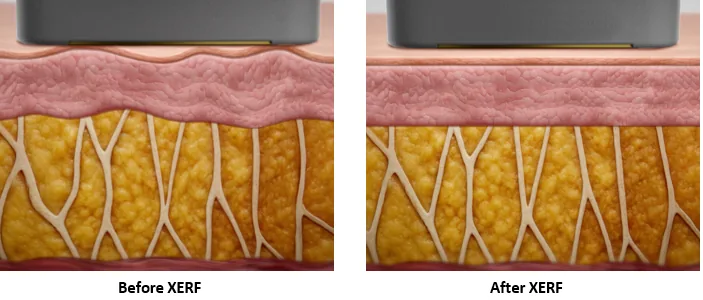 Illustration of skin layers before and after XERF, the tissue appearing tighter and more compact after treatment