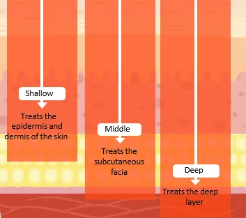 Diagram of XERF's three treatment depths: shallow treats the epidermis and dermis, middle treats the subcutaneous fascia, deep treats the deep layer
