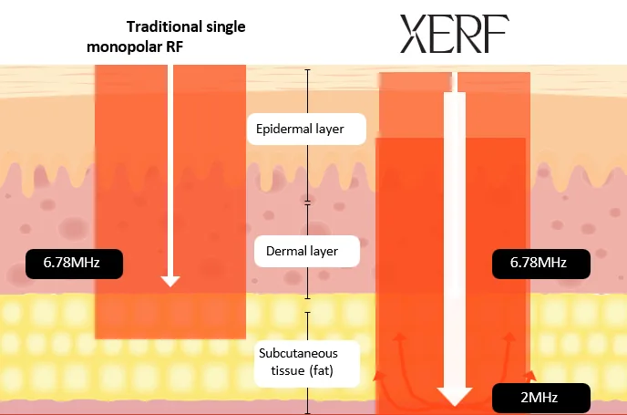 Diagram comparing traditional single monopolar RF at 6.78 MHz, which reaches the dermal layer, with XERF at 6.78 MHz and 2 MHz, which reaches the subcutaneous tissue