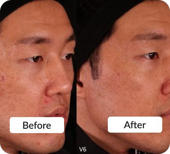 Skin treatment Before & After photo