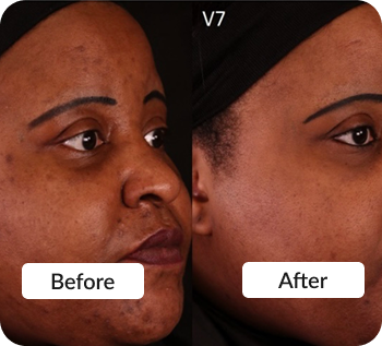 Skin treatment Before & After photo