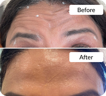 Skin treatment Before & After photo