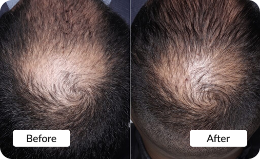 PRP Hair Restoration - Before & After photo