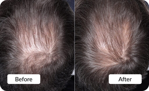 PRP Hair Restoration - Before & After photo