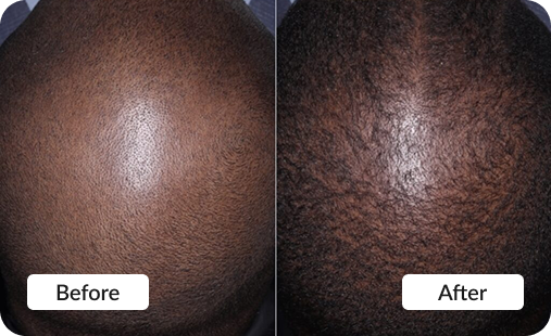PRP Hair Restoration - Before & After photo