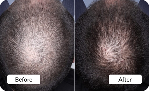 PRP Hair Restoration - Before & After photo