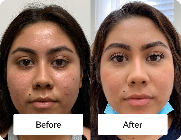 Microneedling Before and After Photo