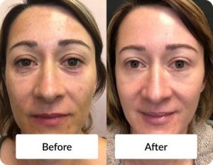 Microneedling PRP Before & After