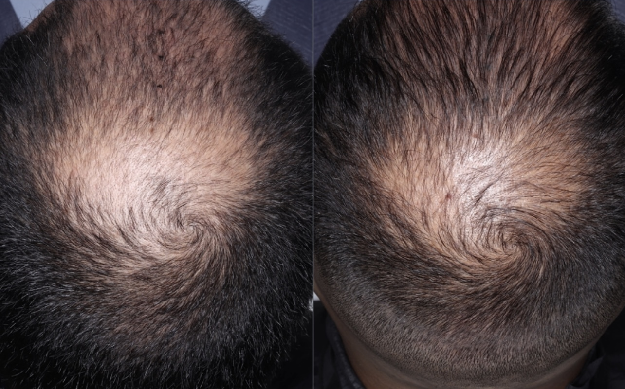 PRP Hair Restoration Before & After