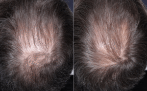 PRP Hair Restoration Before & After