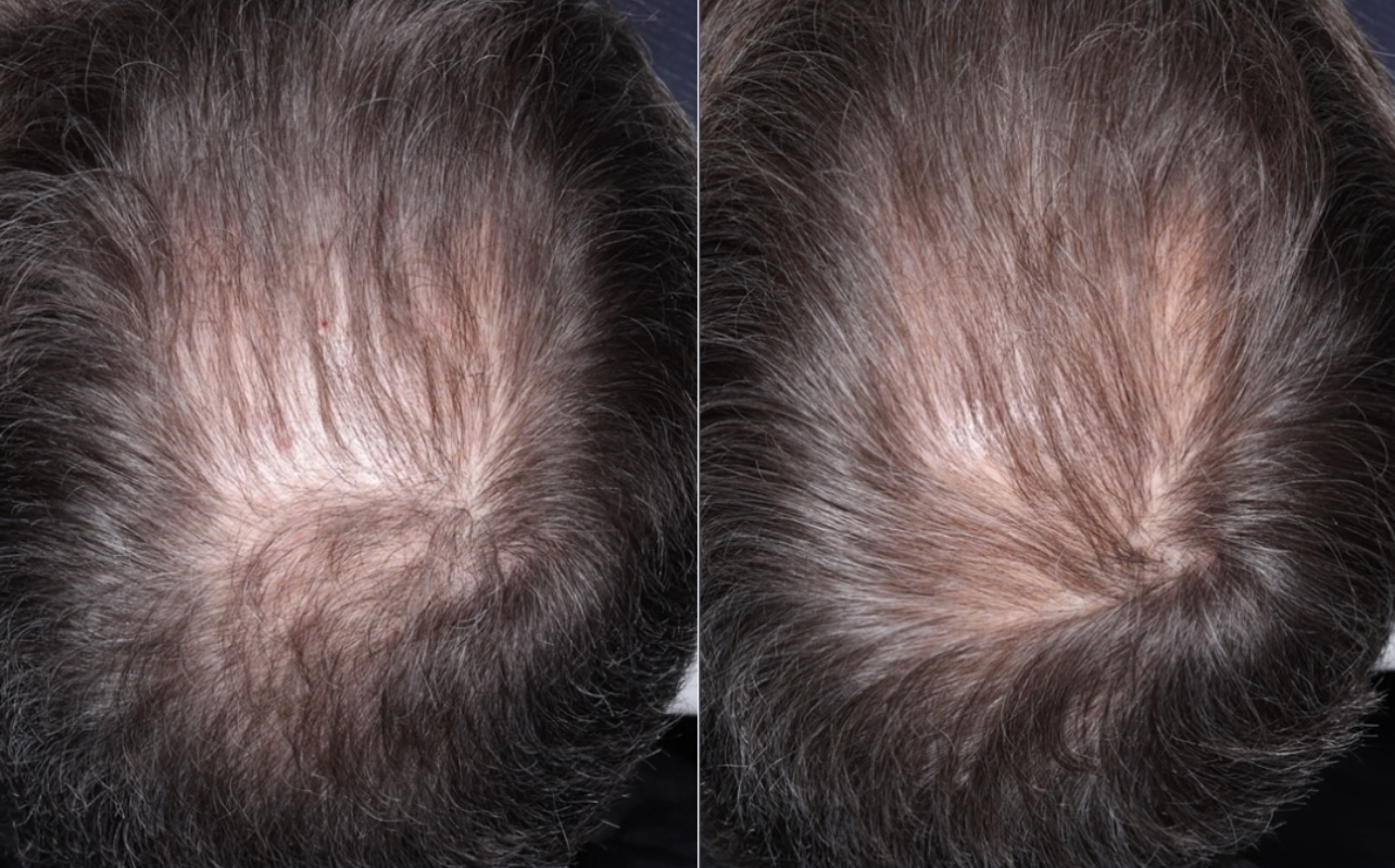 PRP Hair Restoration Before & After