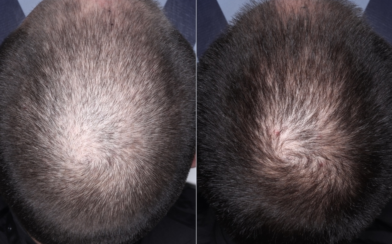 PRP Hair Restoration Before & After