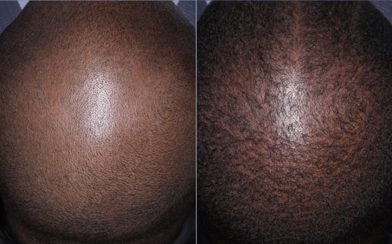 PRP Hair Restoration Before & After