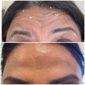 Botox - Before & After Photo