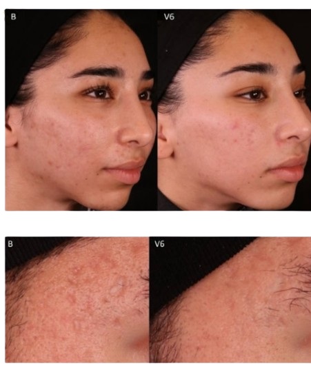 Microneedling Session Before After