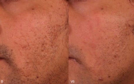 Microneedling Session Before After